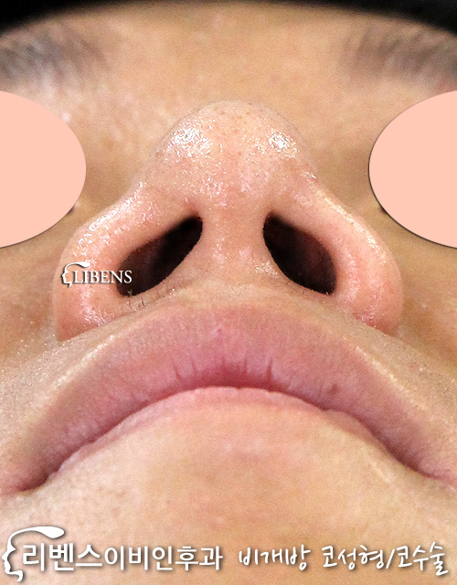 눌린 콧구멍 코끝 성형 수술 교정 무보형물 연골재배치 성형 s583
